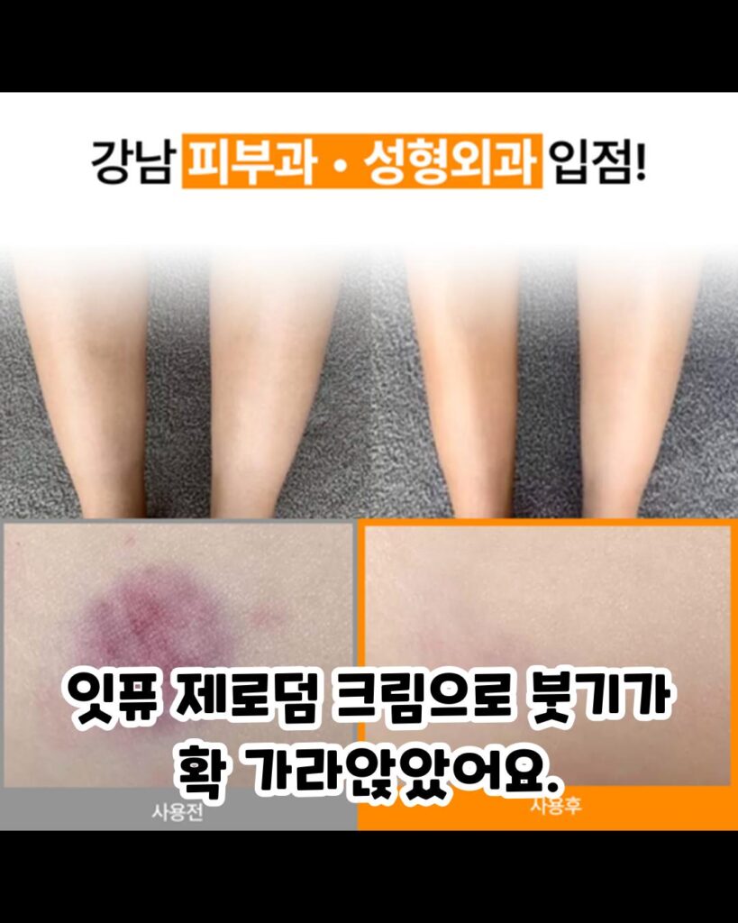 붓기와 멍 잇퓨 제로덤 크림으로 해결하세요